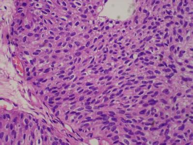 美國FDA授予avelumab治療尿路上皮癌優先審查資格