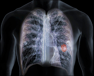 羅氏公佈Alectinib新資料：無進展生存期高達34.8個月，ALK+肺癌實現慢性病轉變