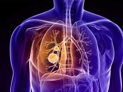 罗氏T药联合疗法Ⅲ期临床试验均到终点，有望一线治疗肺癌
